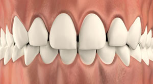 Too Much Space Between Teeth